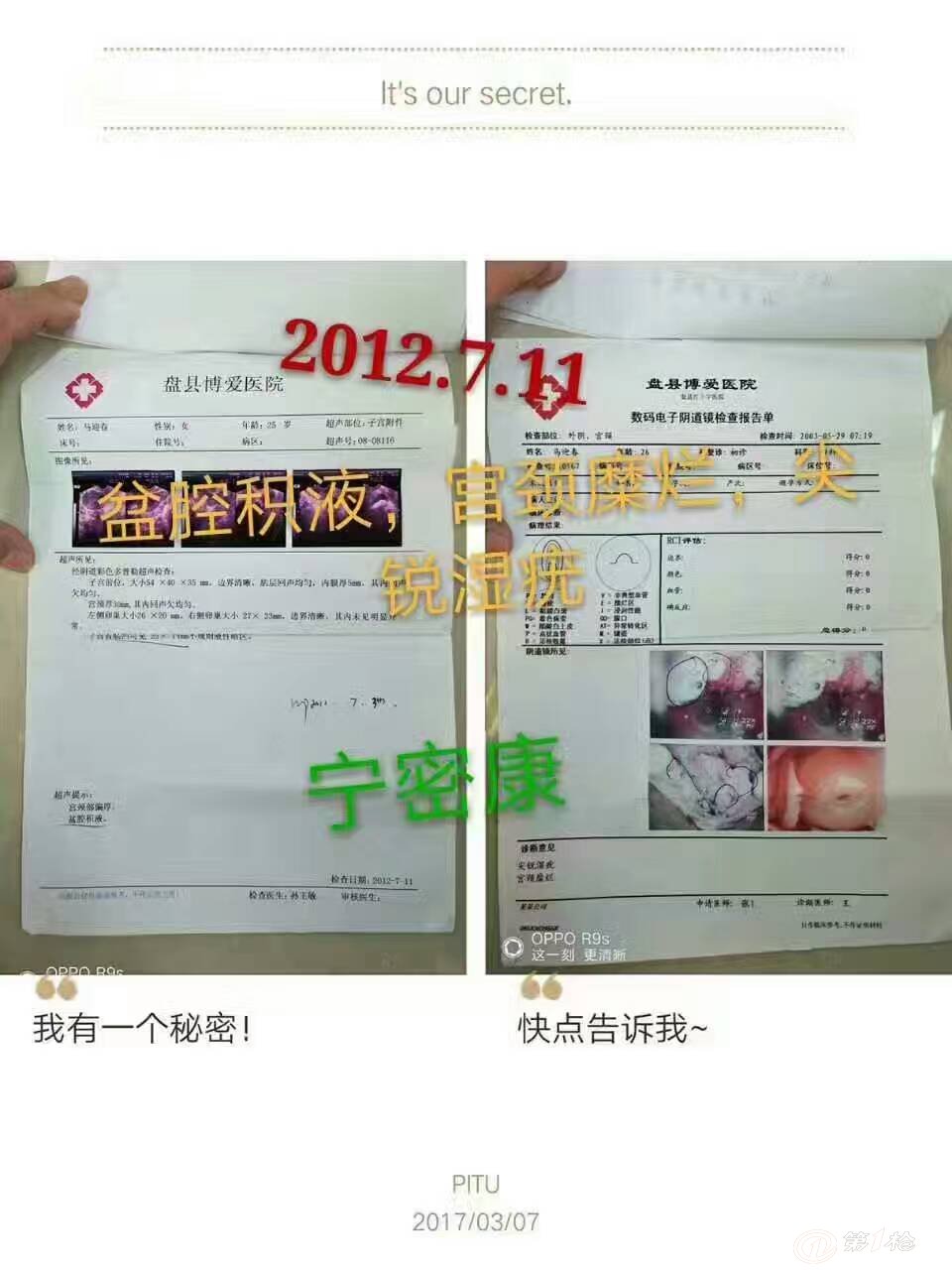 宫颈糜烂盆腔积液hpv阳性用宁密康调理好案例