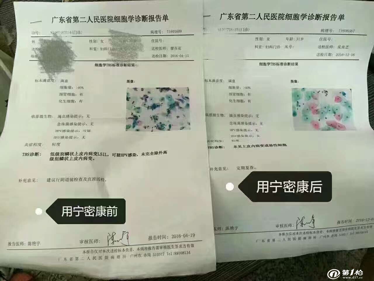 hpv病毒高危感染低级别鳞状上皮内病变用宁密康调理好