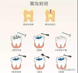 牙齿种植-牙齿种植