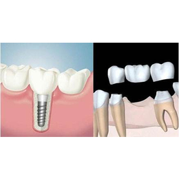 种植牙术前要做哪些准备_淄博诺尔漫齿科种植牙手术前准备事项缩略图
