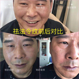 哪里*黑眼圈效果好？_魅龄童颜(在线咨询)_*