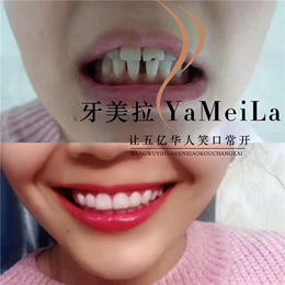 牙美拉树脂贴面技术_上海牙齿*加盟_牙美拉