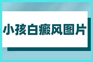 白点癫风会传染给下一代吗-是遗传病吗