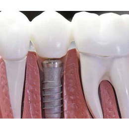 牙种植体- 钟祥市小灰兔-牙种植体哪里好